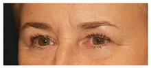 Eyelid Surgery Before Photo by Michael Law, MD; Raleigh, NC - Case 33880