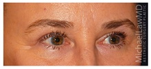 Eyelid Surgery After Photo by Michael Law, MD; Raleigh, NC - Case 33880