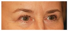 Eyelid Surgery Before Photo by Michael Law, MD; Raleigh, NC - Case 33880