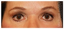 Eyelid Surgery After Photo by Michael Law, MD; Raleigh, NC - Case 33891