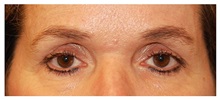 Eyelid Surgery Before Photo by Michael Law, MD; Raleigh, NC - Case 33891