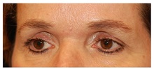 Eyelid Surgery Before Photo by Michael Law, MD; Raleigh, NC - Case 33891