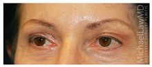 Eyelid Surgery After Photo by Michael Law, MD; Raleigh, NC - Case 33892