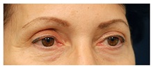 Eyelid Surgery Before Photo by Michael Law, MD; Raleigh, NC - Case 33892