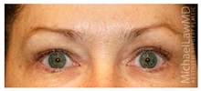 Eyelid Surgery After Photo by Michael Law, MD; Raleigh, NC - Case 33893