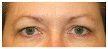 Eyelid Surgery Before Photo by Michael Law, MD; Raleigh, NC - Case 33893