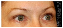 Eyelid Surgery After Photo by Michael Law, MD; Raleigh, NC - Case 33893