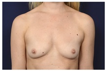 Breast Augmentation Before Photo by Michael Law, MD; Raleigh, NC - Case 34021