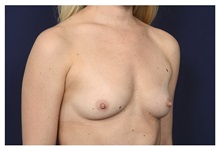 Breast Augmentation Before Photo by Michael Law, MD; Raleigh, NC - Case 34021