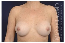 Breast Augmentation After Photo by Michael Law, MD; Raleigh, NC - Case 34108
