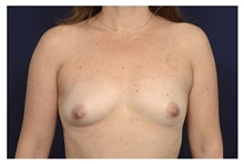 Breast Augmentation Before Photo by Michael Law, MD; Raleigh, NC - Case 34108