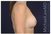 Breast Augmentation After Photo by Michael Law, MD; Raleigh, NC - Case 34108