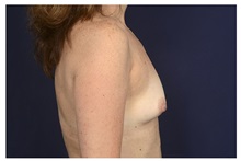 Breast Augmentation Before Photo by Michael Law, MD; Raleigh, NC - Case 34108