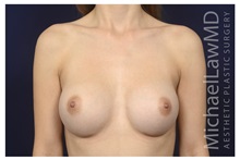 Breast Augmentation After Photo by Michael Law, MD; Raleigh, NC - Case 34109