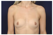 Breast Augmentation Before Photo by Michael Law, MD; Raleigh, NC - Case 34109