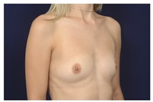 Breast Augmentation Before Photo by Michael Law, MD; Raleigh, NC - Case 34109