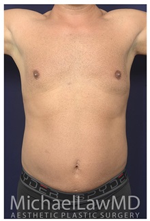 Liposuction After Photo by Michael Law, MD; Raleigh, NC - Case 34136