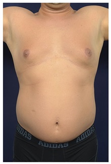 Liposuction Before Photo by Michael Law, MD; Raleigh, NC - Case 34136