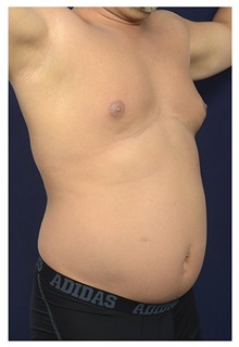 Liposuction Before Photo by Michael Law, MD; Raleigh, NC - Case 34136