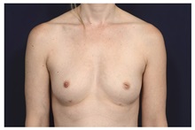 Breast Augmentation Before Photo by Michael Law, MD; Raleigh, NC - Case 34137