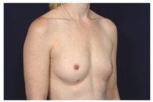 Breast Augmentation Before Photo by Michael Law, MD; Raleigh, NC - Case 34137