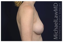 Breast Augmentation After Photo by Michael Law, MD; Raleigh, NC - Case 34137