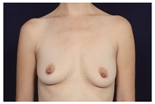 Breast Augmentation Before Photo by Michael Law, MD; Raleigh, NC - Case 34170