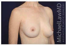 Breast Augmentation After Photo by Michael Law, MD; Raleigh, NC - Case 34170