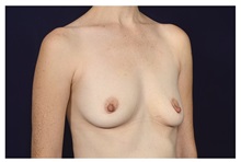 Breast Augmentation Before Photo by Michael Law, MD; Raleigh, NC - Case 34170