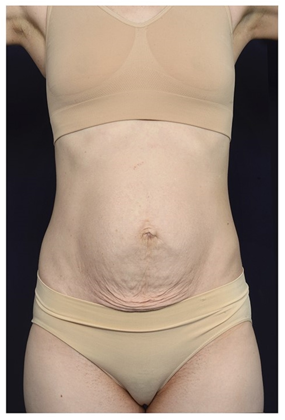 Reverse Upper Modified Lower Abdominoplasty Before & After Photos Raleigh  NC 27614