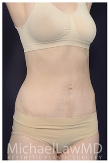 Tummy Tuck After Photo by Michael Law, MD; Raleigh, NC - Case 34172