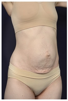 Tummy Tuck Before Photo by Michael Law, MD; Raleigh, NC - Case 34172