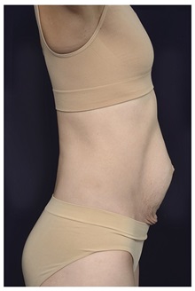 Tummy Tuck Before Photo by Michael Law, MD; Raleigh, NC - Case 34172