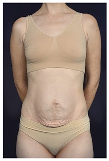 Body Contouring Before Photo by Michael Law, MD; Raleigh, NC - Case 34173