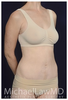 Body Contouring After Photo by Michael Law, MD; Raleigh, NC - Case 34173