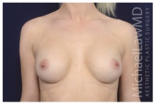 Breast Augmentation After Photo by Michael Law, MD; Raleigh, NC - Case 34194