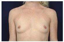 Breast Augmentation Before Photo by Michael Law, MD; Raleigh, NC - Case 34194