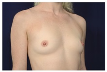 Breast Augmentation Before Photo by Michael Law, MD; Raleigh, NC - Case 34194