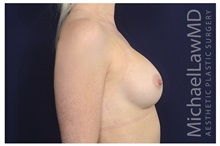 Breast Augmentation After Photo by Michael Law, MD; Raleigh, NC - Case 34194