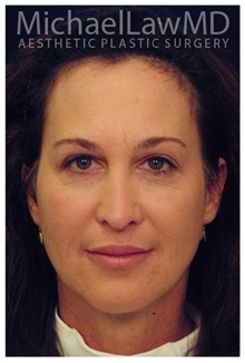 Facelift After Photo by Michael Law, MD; Raleigh, NC - Case 34222