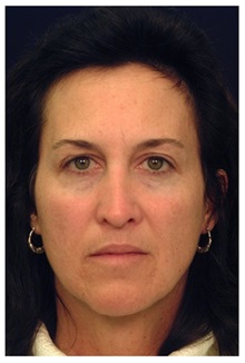 Facelift Before Photo by Michael Law, MD; Raleigh, NC - Case 34222