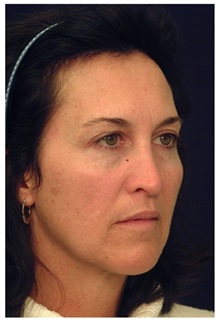 Facelift Before Photo by Michael Law, MD; Raleigh, NC - Case 34222