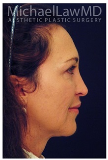 Facelift After Photo by Michael Law, MD; Raleigh, NC - Case 34222