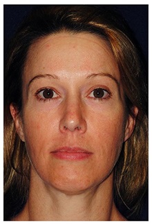 Facelift Before Photo by Michael Law, MD; Raleigh, NC - Case 34223