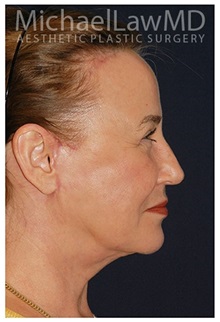 Facelift After Photo by Michael Law, MD; Raleigh, NC - Case 34224