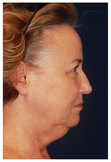 Facelift Before Photo by Michael Law, MD; Raleigh, NC - Case 34224