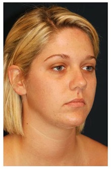 Facelift Before Photo by Michael Law, MD; Raleigh, NC - Case 34225