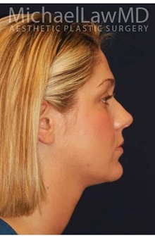 Facelift After Photo by Michael Law, MD; Raleigh, NC - Case 34225