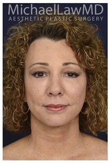 Facelift After Photo by Michael Law, MD; Raleigh, NC - Case 34226