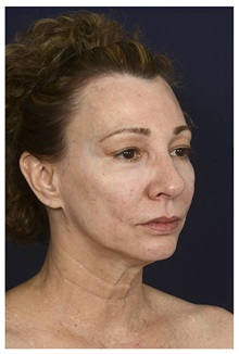 Facelift Before Photo by Michael Law, MD; Raleigh, NC - Case 34226